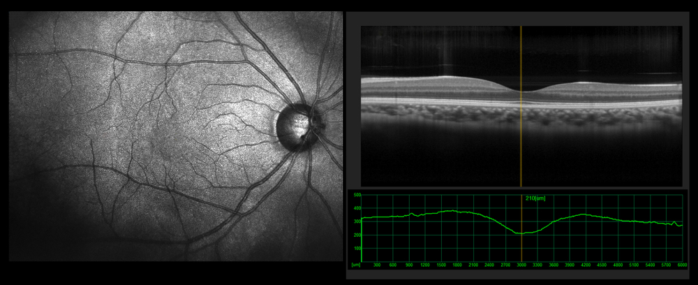 Optical Coherence Tomography